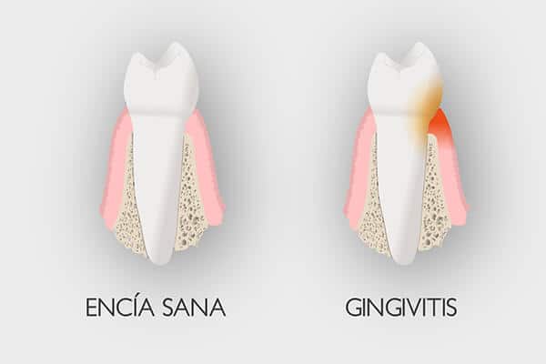 Diseño de la sonrisa