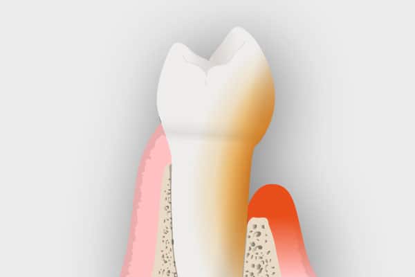 Periodoncia - Enfermedades periodontales