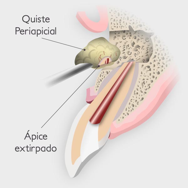 Apicectomía - Retirada del quiste