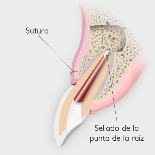 Apicectomía - Sutura