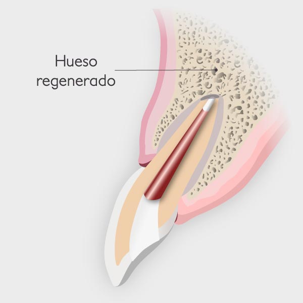 Apicectomía - Regeneración del hueso