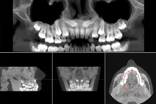 Caninos incluidos - Consecuencias derivadas de las inclusiones dentarias.