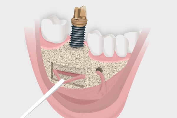 Cirugía oral avanzada - Transposición del nervio dentaría