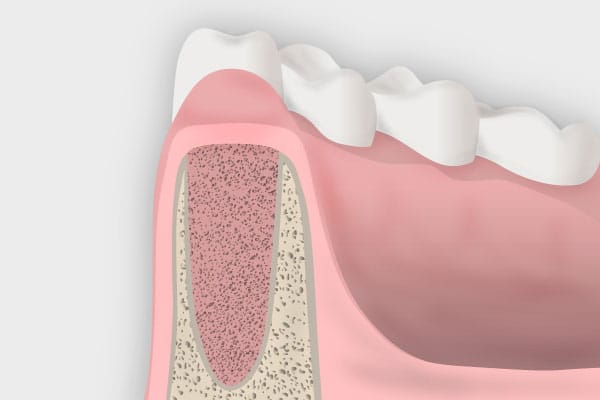 Cirugía oral avanzada - Preservación del reborde alveolar