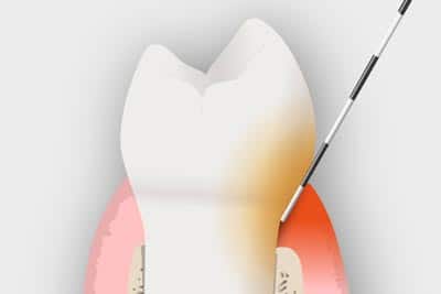 Gingivitis o periodontitis