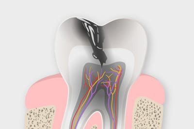 Riesgo de caries