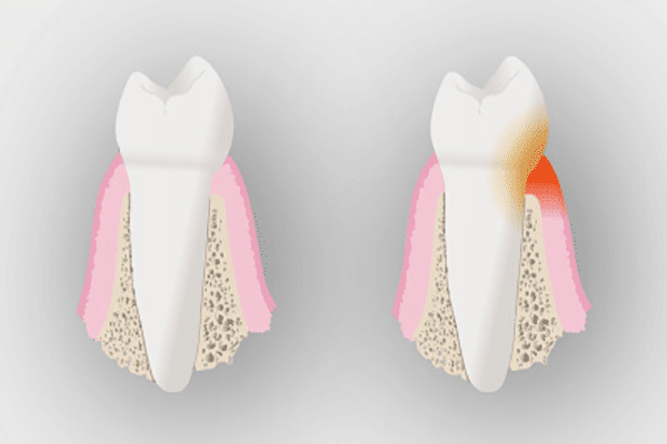 Gingivitis o periodontitis