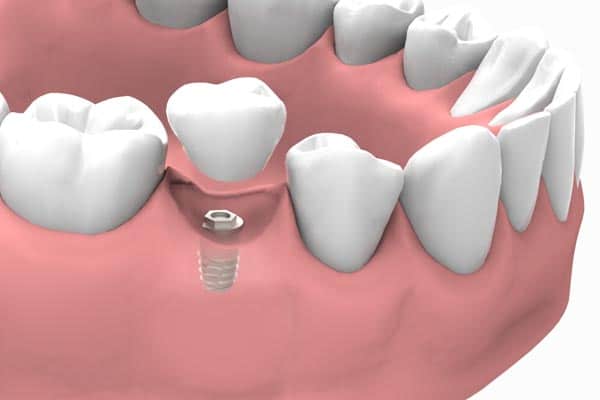 Ventajas de los implantes dentales cortos