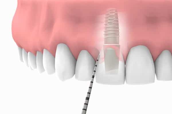 Tratamiento con implantes en la zona estética