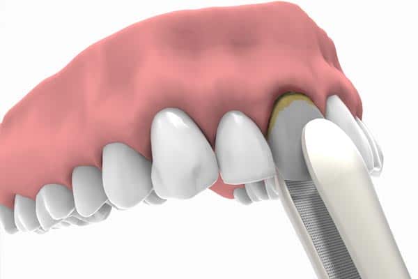 Qué son los implantes inmediatos