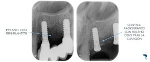 Periimplantitis - Radiografía antes y después