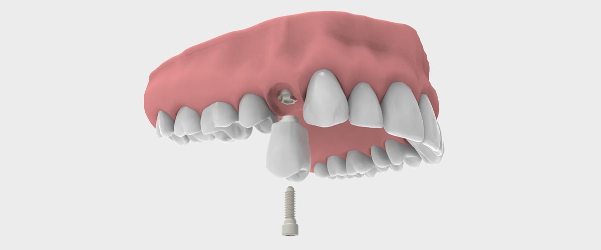 15 Preguntas sobre implantes dentales