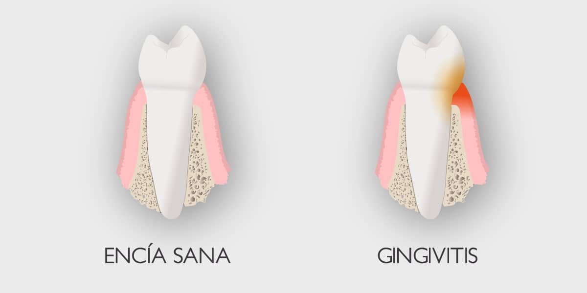 Enfermedad periodontal - Gingivitis.