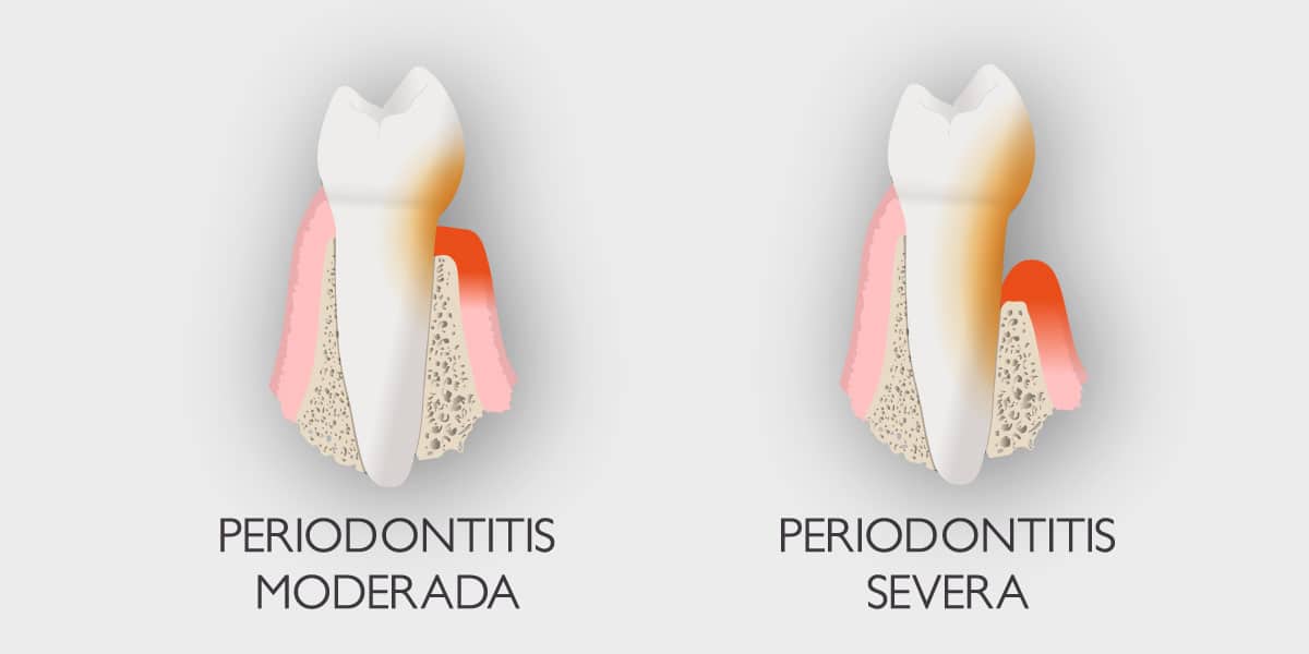 Enfermedad periodontal - Periodontitis.