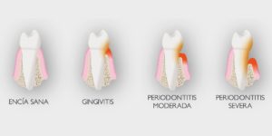 Encías inflamadas. Principales causas.