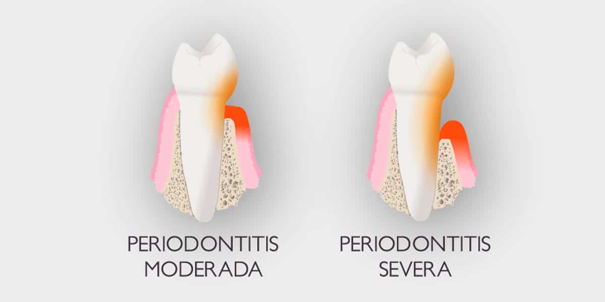 Periodontitis o piorrea ¿qué es?