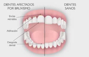 Consecuencias del bruxismo