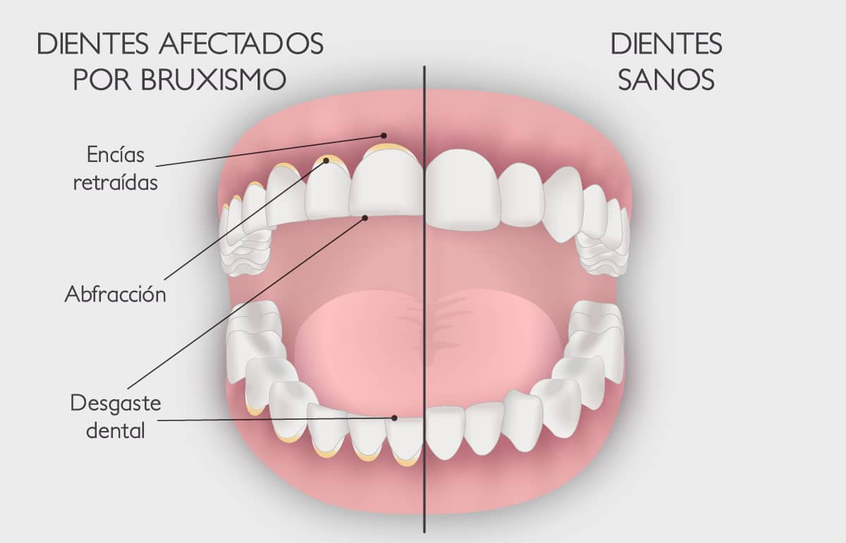 Bruxismo - Causas y tratamiento de apretar los dientes - Clínica Pardiñas