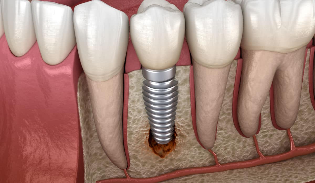 ¿Cuándo es necesario acudir al implantólogo? - Periimplantitis