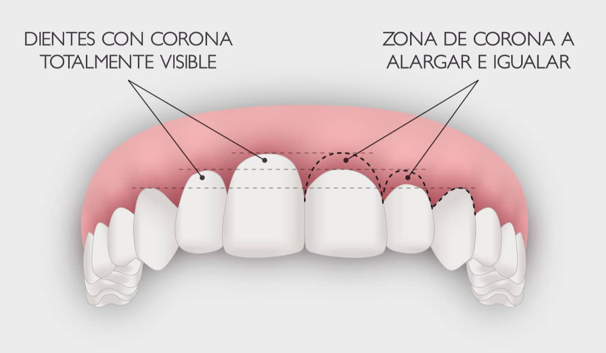 Técnicas para la corrección de la sonrisa gingival.