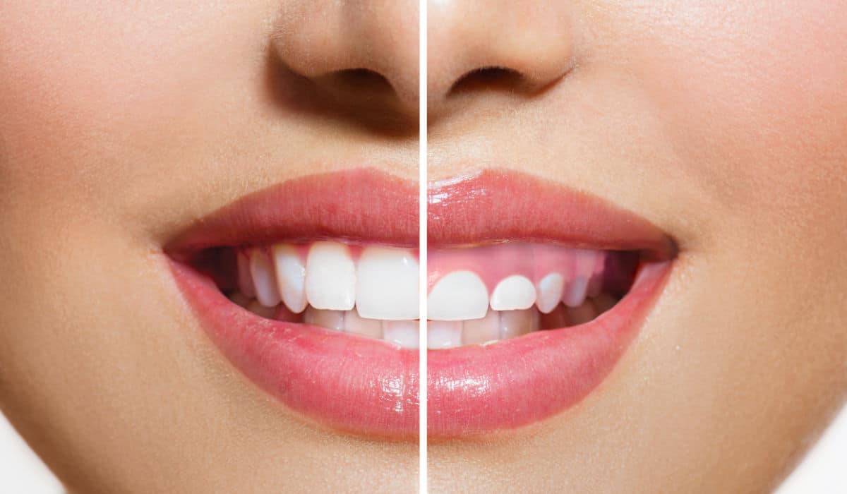 ¿Qué es la sonrisa gingival?