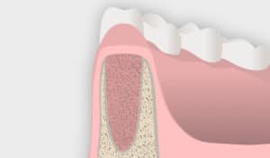 Fases del tratamiento de preservación del reborde alveolar