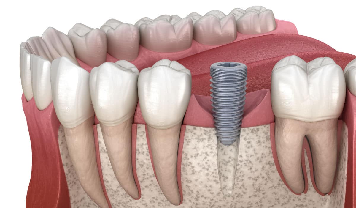 Estructura ósea para la colocación de implantes dentales