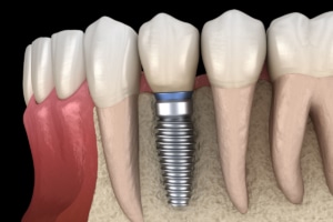 Osteointegración de los implantes dentales ¿en qué consiste?