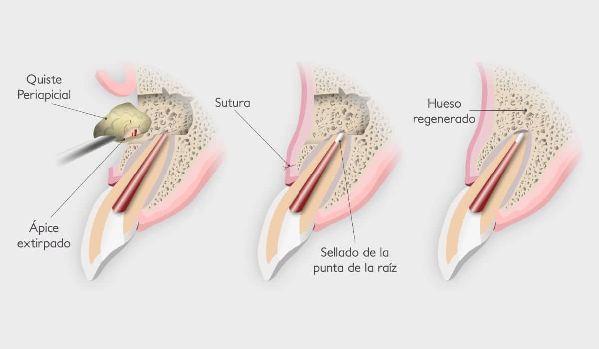 Fases de una apicectomía