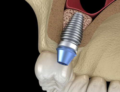 Regeneración ósea: la solución para poner implantes dentales