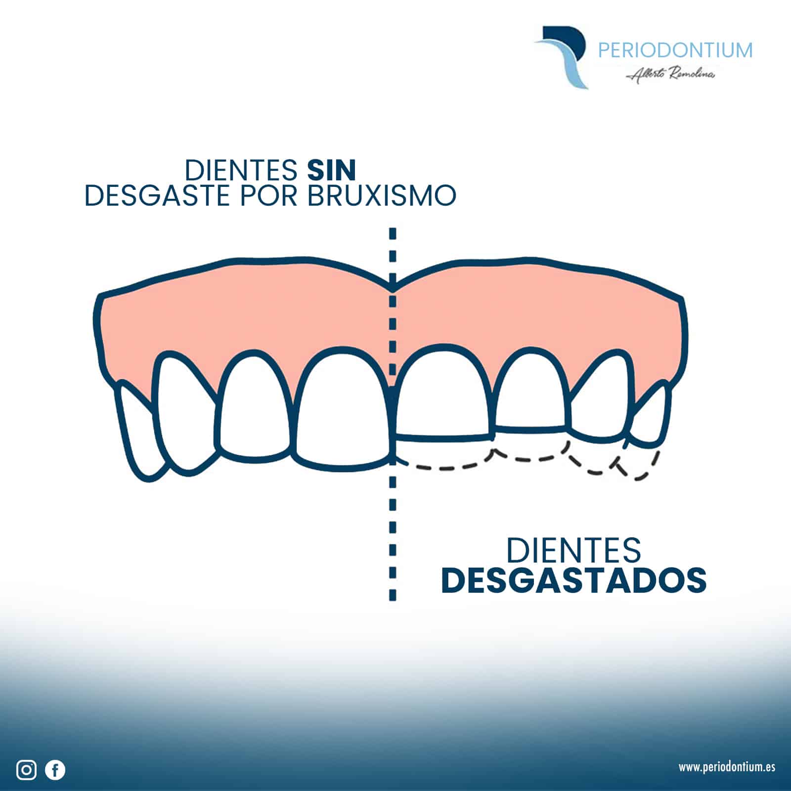 Solución al desgaste de los dientes por bruxismo