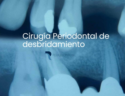 Cirugía Periodontal de Desbridamiento: Un paso para la salud de tus encías