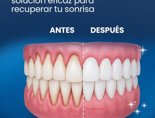 Encías retraídas: solución eficaz para recuperar tu sonrisa
