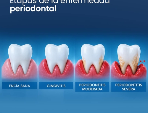 ¿La periodontitis se puede curar?